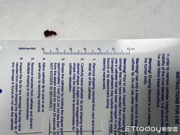 ▲血栓。（圖／衛福部南投醫院提供，下同）