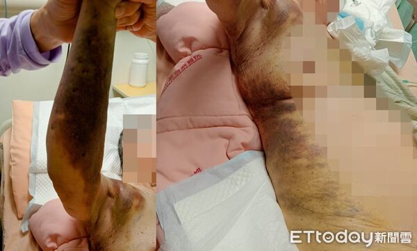 ▲家屬指控護理中心虐待94歲高齡母親，身體右半邊全是瘀青。（圖／記者唐詠絮翻攝）