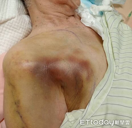 ▲家屬指控護理中心虐待94歲高齡母親，身體右半邊全是瘀青。（圖／記者唐詠絮翻攝）