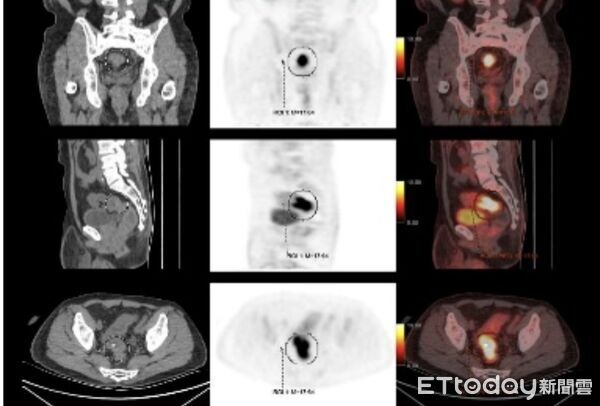 ▲▼腹痛1個多月！43歲男消化不良就醫　竟罹「直腸癌第3期」嚇壞。（圖／記者賴文萱翻攝）