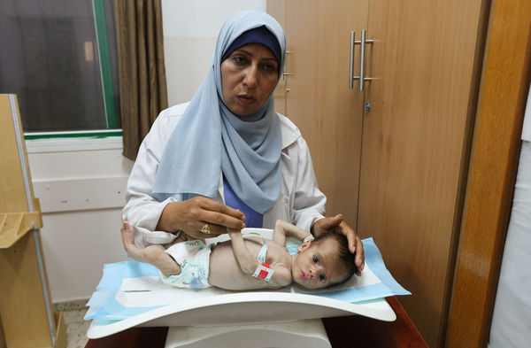 ▲▼加薩南部汗尤尼斯（Khan Younis）納賽爾綜合醫療中心（Nasser Medical Complex）兒童營養不良病房內，寶寶手臂幾乎只跟媽媽拇指一樣細。（圖／路透）