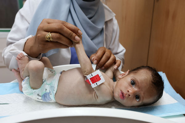 ▲▼加薩南部汗尤尼斯（Khan Younis）納賽爾綜合醫療中心（Nasser Medical Complex）兒童營養不良病房內，寶寶手臂幾乎只跟媽媽拇指一樣細。（圖／路透）