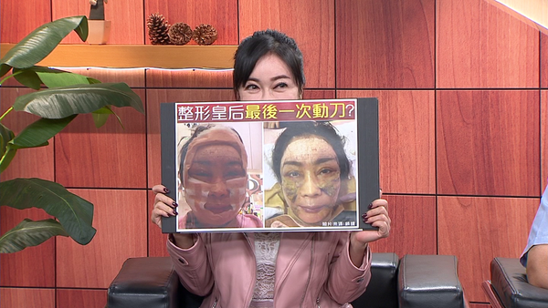 ▲▼顧婕今年施作三層筋膜大拉皮手術。（圖／年代提供）