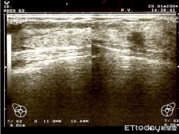 ▲張女士罹患荷爾蒙陽性乳癌，追蹤長達16年突復發並且骨轉移。（圖／記者許宥孺翻攝）
