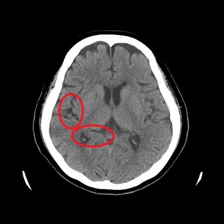 ▲▼腦部核磁共振影像檢查出大腦顯著萎縮。（圖／亞大醫院提供）