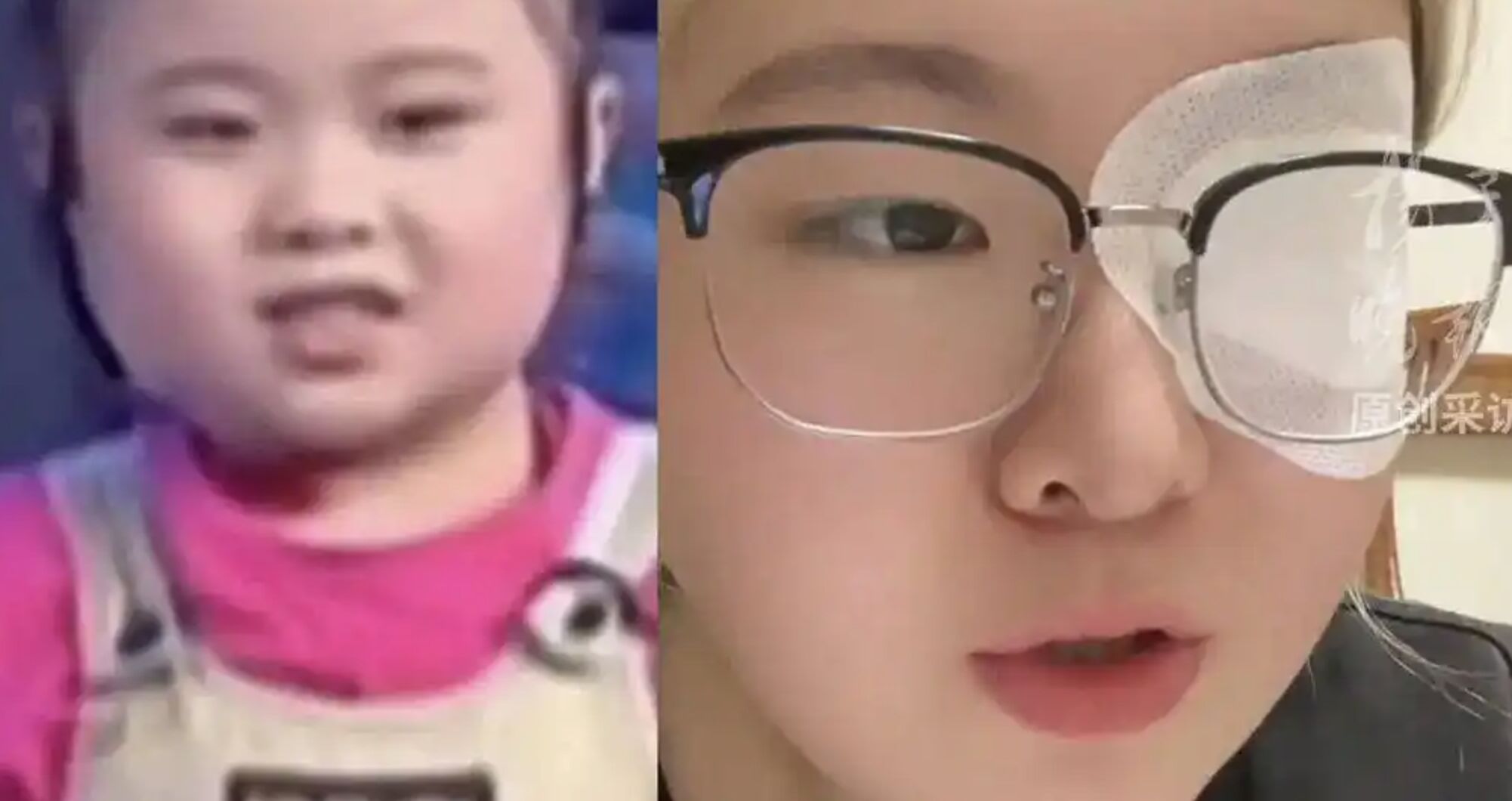 ▲大陸前童星吳煜輝患「美女病」右眼失明。（圖／翻攝微博）