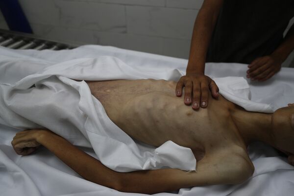 ▲▼ 巴勒斯坦17歲少年阿布哈特（Atef Abu Khater）嚴重營養不良過世。（圖／VCG）