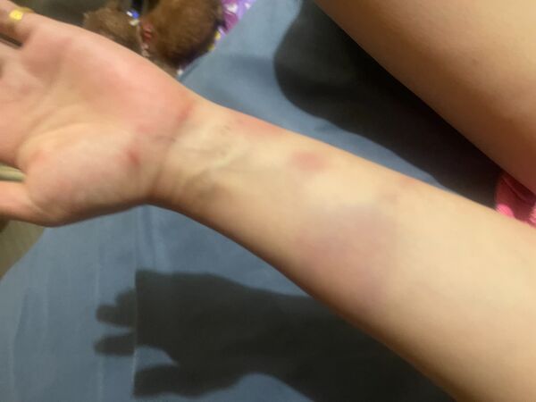 ▲侯沁潔公開傷勢照。（圖／侯沁潔提供）