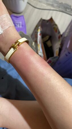 ▲侯沁潔公開傷勢照。（圖／侯沁潔提供）