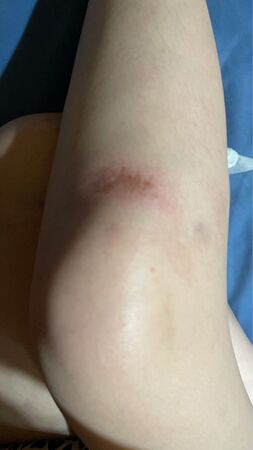 ▲侯沁潔公開傷勢照。（圖／侯沁潔提供）