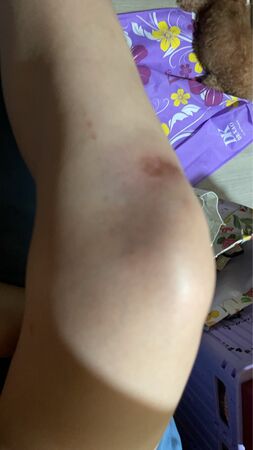 ▲侯沁潔公開傷勢照。（圖／侯沁潔提供）