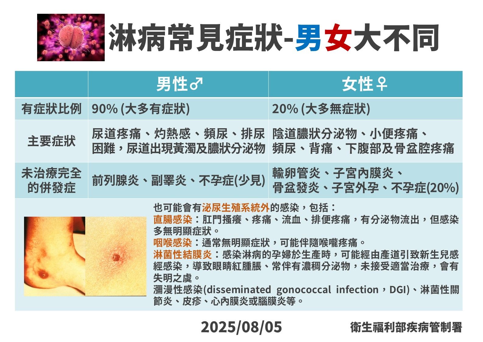 ▲▼ 淋病常見症狀。（圖／疾管署提供）