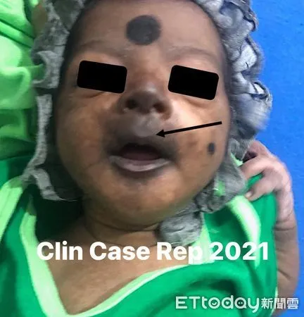 ▲▼  屈公病           。（翻攝吳昌騰醫師臉書）