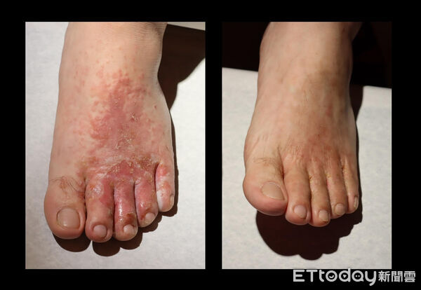 ▲茂盛醫院,香港腳,鍾佩宜。（圖／記者游瓊華攝）