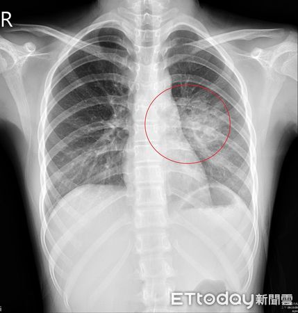 ▲險罹癌王！12歲女童狂咳發燒住院，竟是超罕病「先天性肺氣道畸形」。（圖／亞大附醫提供）