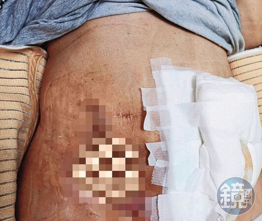 Ａ小姐的傷口從去年底開始發炎，後來更轉為黑紫色，輾轉到台大醫院進行清創。（當事人提供）