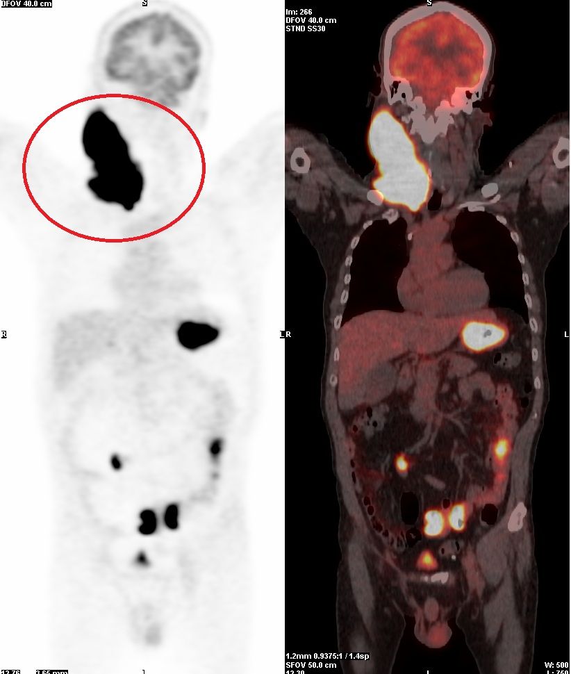 ▲淋巴癌,亞大附醫,賴彥廷,血液腫瘤科。（圖／亞大醫院提供）