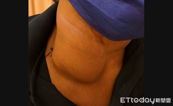 ▲淋巴癌,亞大附醫,賴彥廷,血液腫瘤科。（圖／亞大醫院提供）