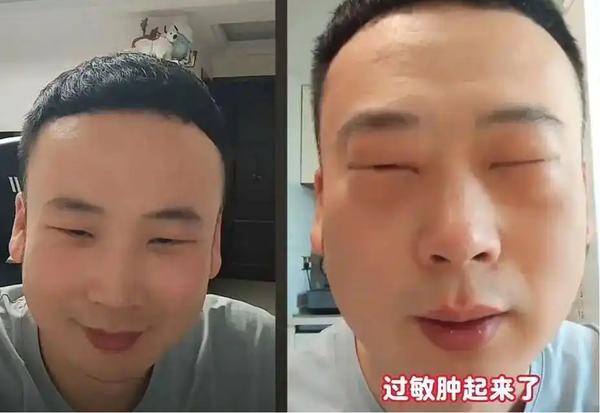 ▲▼  大陸男子吃蟬蛹眼睛腫           。（圖／翻攝 封面新聞、百度）