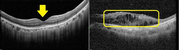 ▲▼正常黃斑部的結構層次分明，中央呈現凹陷（圖左箭頭處），而黃斑部病變會因水腫造成結構模糊、隆起（圖右框線處）。（圖／土城醫院提供）