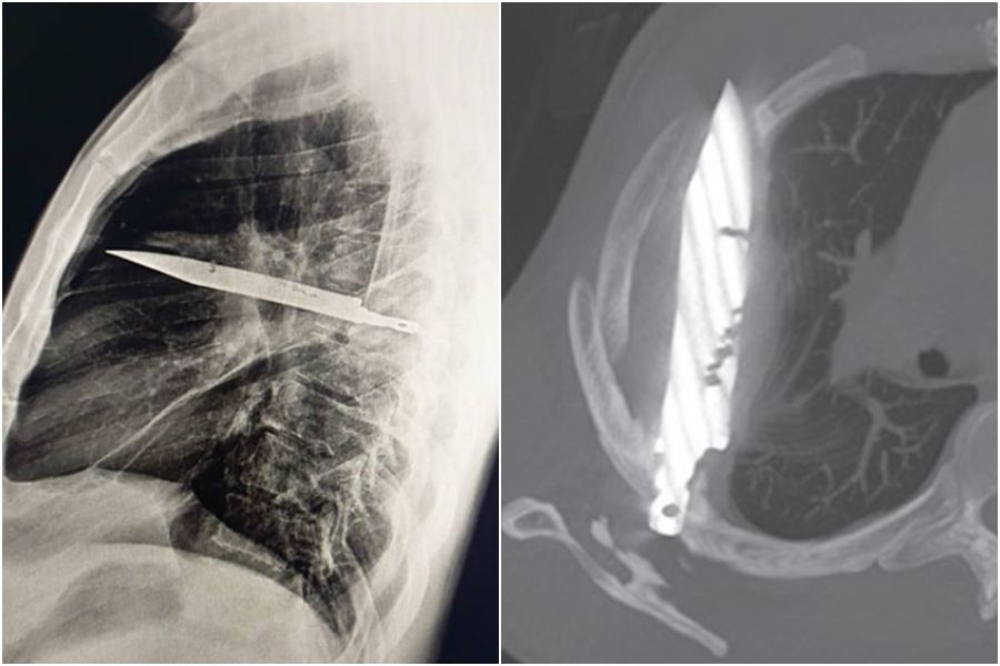 ▲▼             。（圖／翻攝自Journal of Surgical Case Reports）