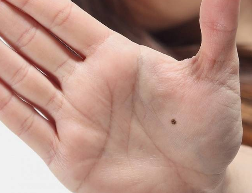 ▲▼快檢查！這6個位置的痣可能變成癌症！。（圖／翻攝自SOHA）