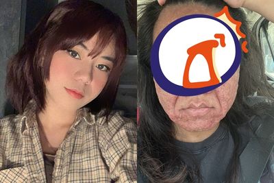 她孕後「滿臉痘+鼻腫大」對比照曝！　醫揭真相：很常見