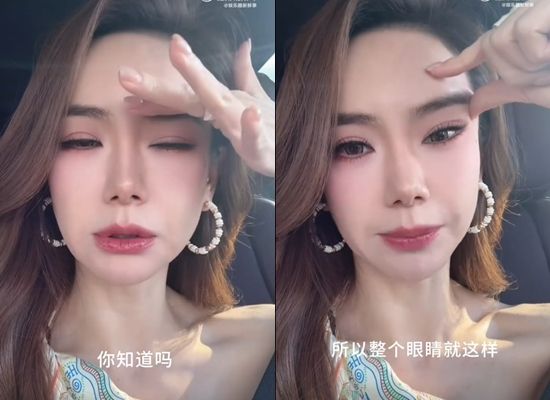 ▲戚薇肉毒打過量。（圖／翻攝自戚薇微博）