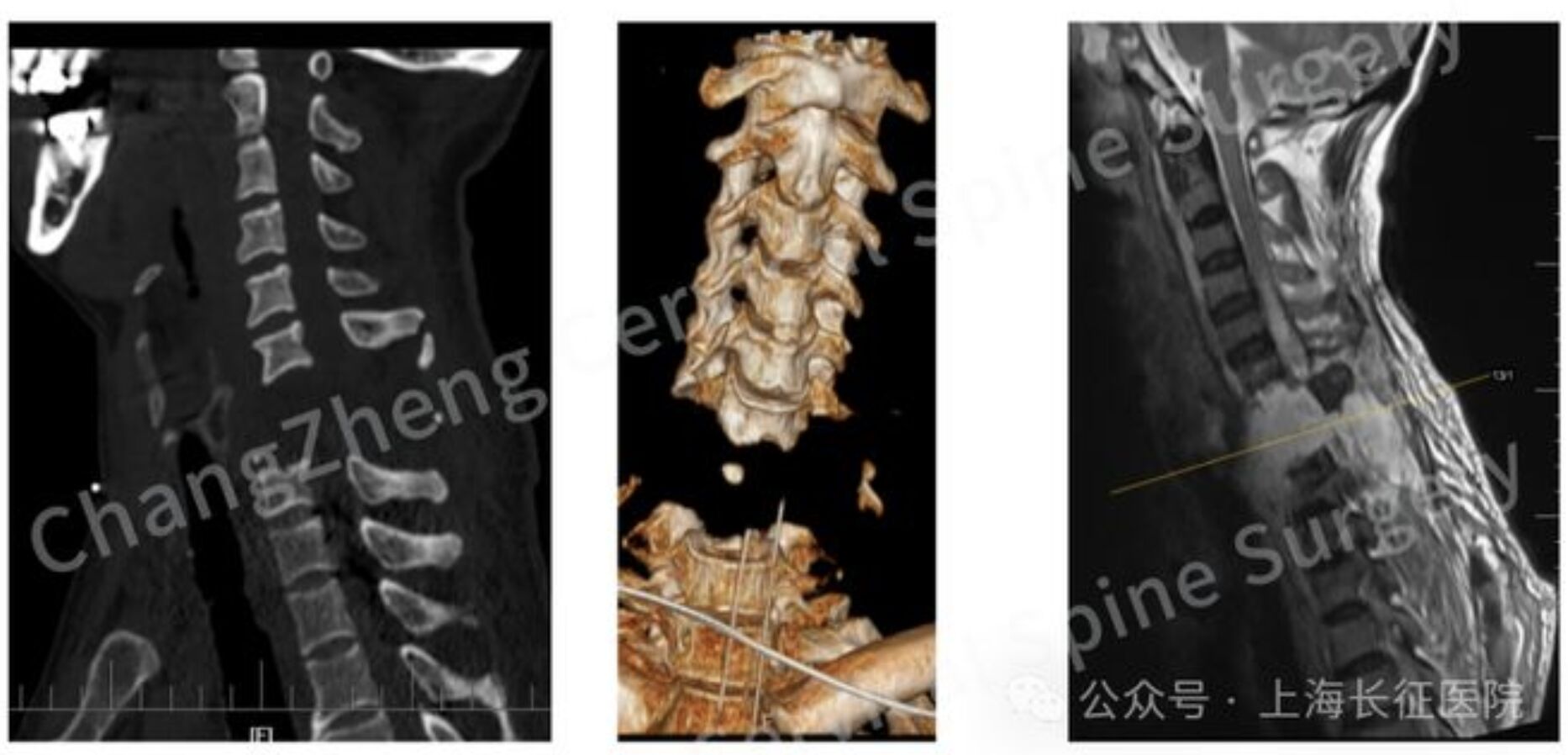 ▲一名遭機械臂重擊的患者脊椎斷裂如同「斷頭」。（圖／翻攝上海長征醫院）