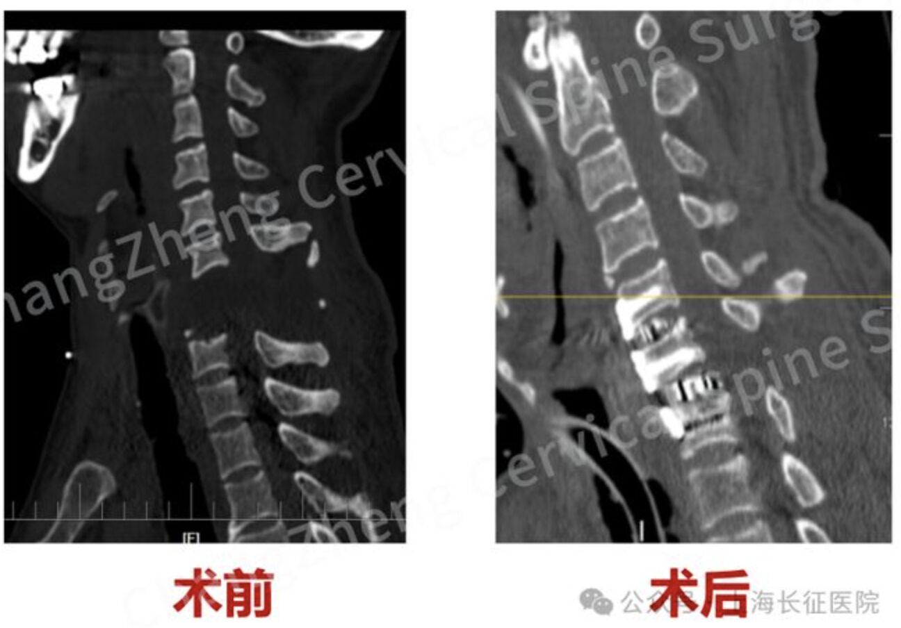 ▲一名遭機械臂重擊的患者脊椎斷裂如同「斷頭」。（圖／翻攝上海長征醫院）