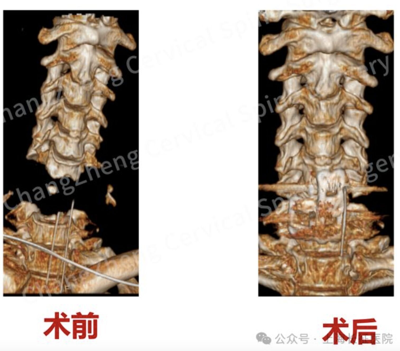 ▲一名遭機械臂重擊的患者脊椎斷裂如同「斷頭」。（圖／翻攝上海長征醫院）