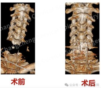 陸醫院奇蹟救回「頸椎斷開」患者一命 醫師曝:情況惡劣如斷頭