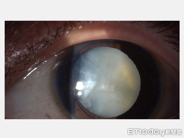 ▲白內障。（圖／大里仁愛醫院提供）