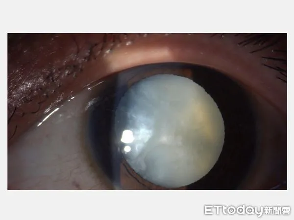 ▲白內障。（圖／大里仁愛醫院提供）