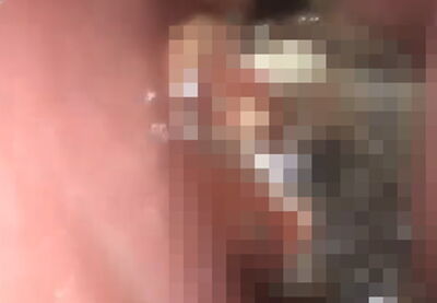 他鼻屎超臭！　醫挖出「一大坨黴菌球」