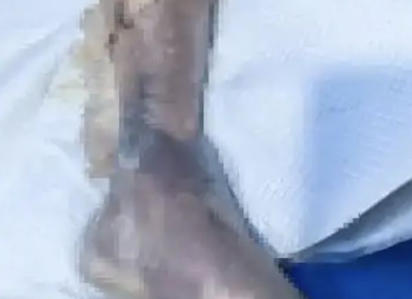 ▲▼陸男遭海鮮刺傷　感染「創傷弧菌」病逝。（圖／翻攝微博）