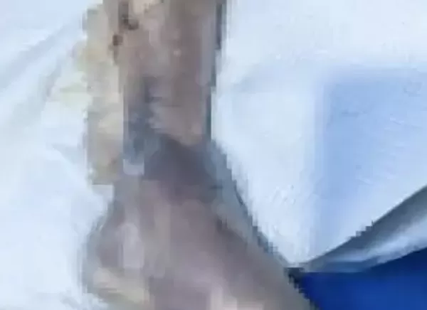 ▲▼陸男遭海鮮刺傷　感染「創傷弧菌」病逝。（圖／翻攝微博）