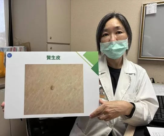 ▲▼書田診所整形美容科主任醫師黃季怡說明贅生皮（Skin Tags）。（圖／書田診所提供）