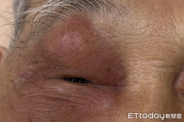 台北慈濟醫院耳鼻喉科醫師吳姳萱,鼻竇炎。（圖／院方提供）