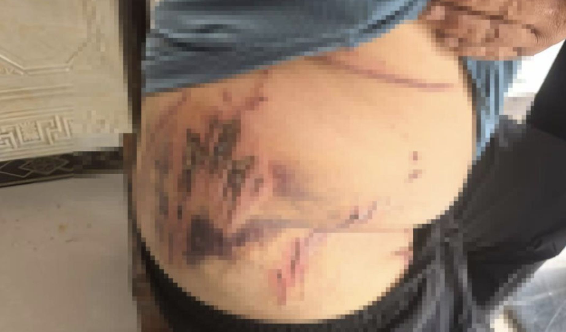 ▲湖北農民自曝遭老虎襲擊，身體留下數道恐怖抓痕。（圖／翻攝極目新聞）