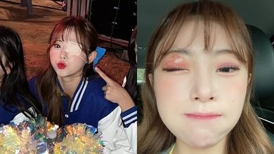 韓啦啦隊女神「1天只睡2小時」患病! 發燒全身痛…恐留永久疤痕