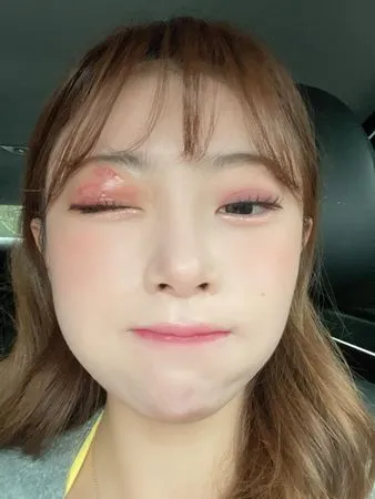 ▲金娜妍眼睛周圍長帶狀皰疹。（圖／翻攝自金娜妍Threads）