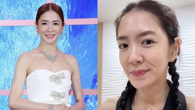 楊千霈摘扁桃腺「失去嗅覺味覺」！　求助中醫臉上扎滿針：挺吃力