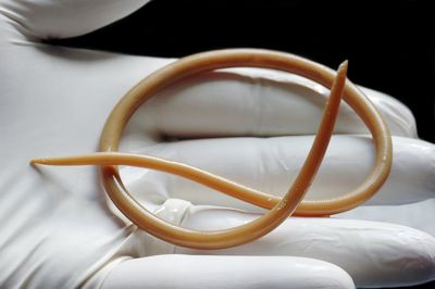 15cm活蟲從鼻子爬出！印尼4歲女體內驚見1kg蛔蟲　昏迷10天亡