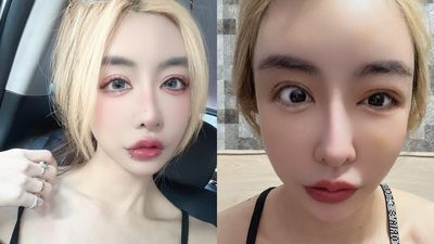 「情色教主」進廠維修眼睛閉不起來! 角膜破洞潰瘍苦撐8月