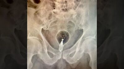 義85歲翁「燈泡爆菊」　拿螺絲起子自救戳到直腸！慘痛求醫