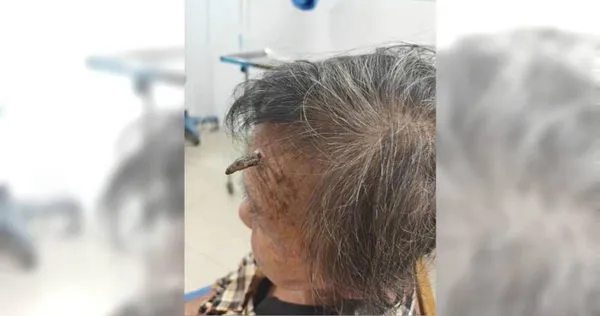 一名98歲的顧姓老婆婆額頭長出一枚形似「犄角」的贅生物。（圖／翻攝自環球網資訊）