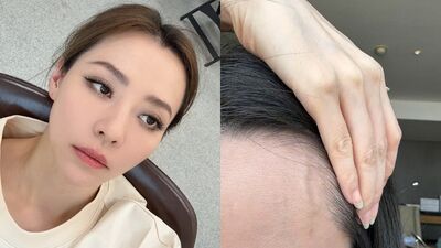 張靚穎健康亮紅燈！伸懶腰就滲血　額頭詭異突一條「查不出原因」　