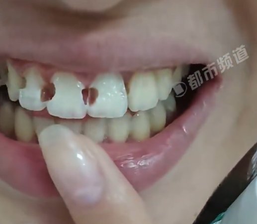 ▲▼醫師指出，王小姐現在需要做根管治療。（圖／翻攝自微博）