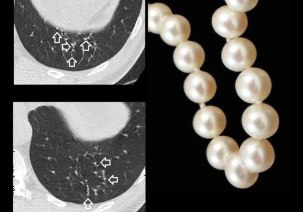 ▲這是鈣化肺結節。（圖／翻攝自臉書／蘇一峰）